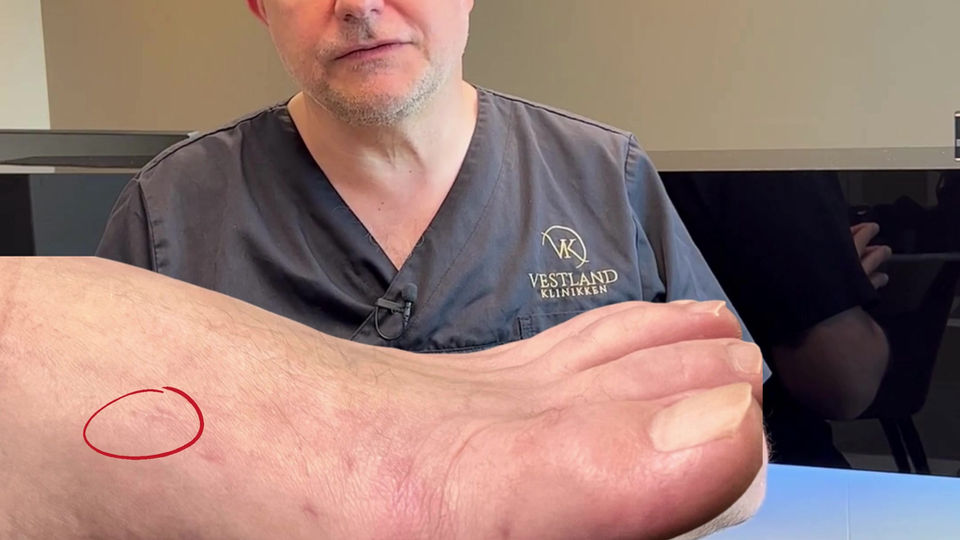 4. "Jeg har hørt at Hallux Valgus operasjon kan bli mislykket?"